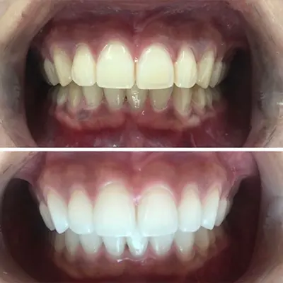 foto ilustrativa Clareamento Dental